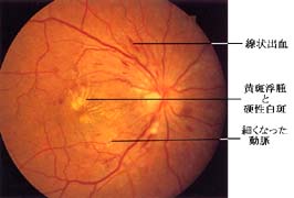高血圧性網膜症の分類ピック
